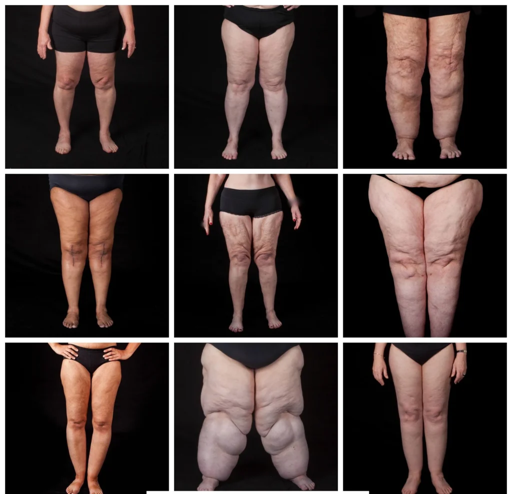 Fighting Fat disorders background image