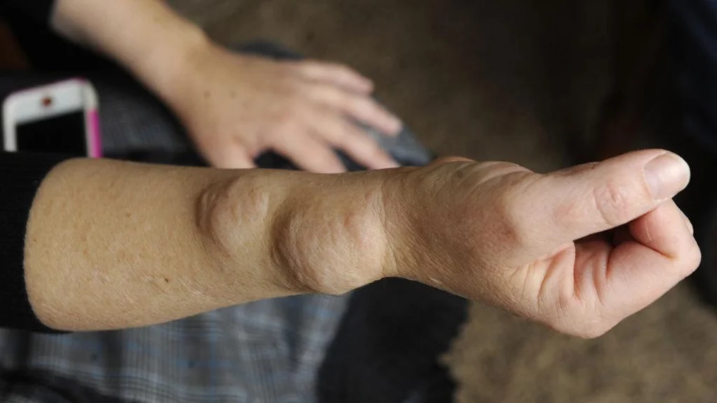 Dercum disease 3
