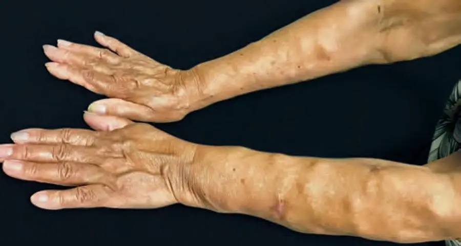 dercum disease