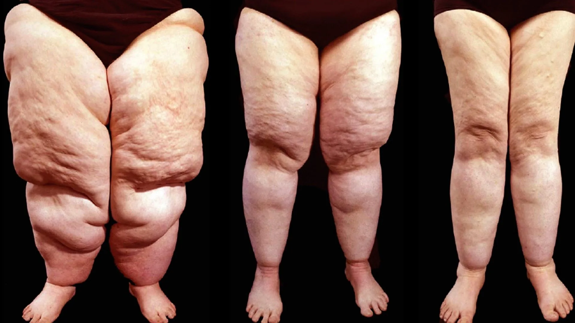lipedema service image