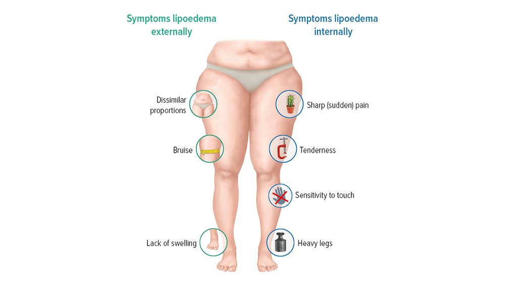 lipedema